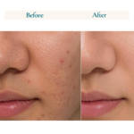 2% BHA Face Serum with i.e Salicylic Acid with Tea Tree Hydrosol & Aloevera l 30ml - Image 3