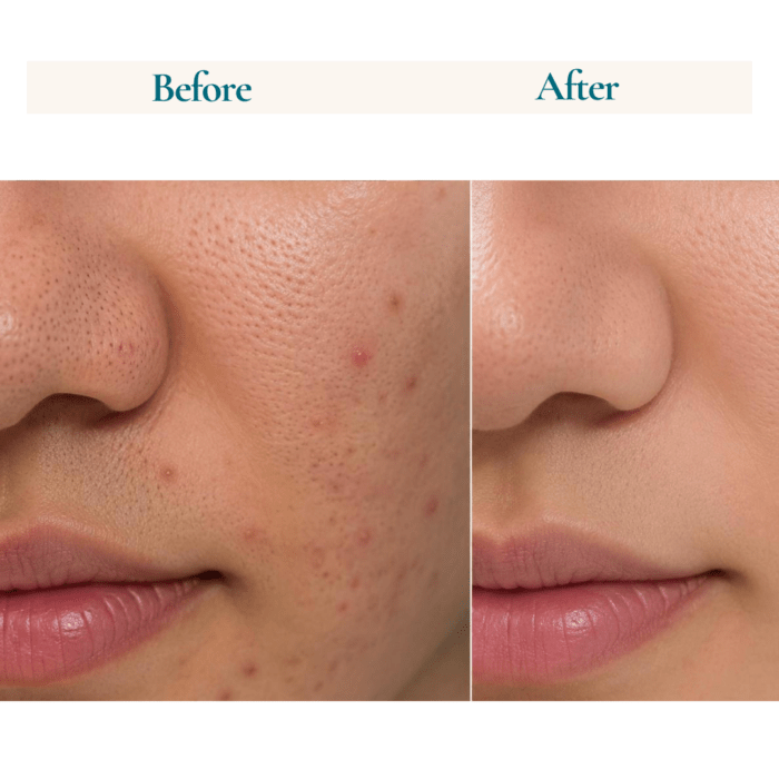 2% BHA Face Serum with i.e Salicylic Acid with Tea Tree Hydrosol & Aloevera l 30ml - Image 3